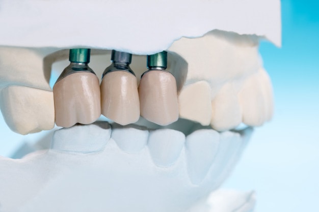 close up implant model tooth support fix bridge