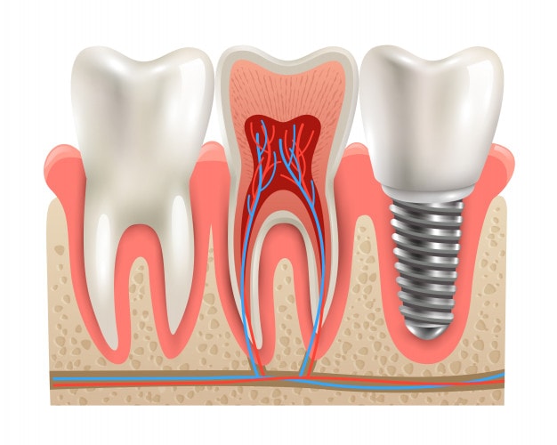 dental implants anatomy closeup